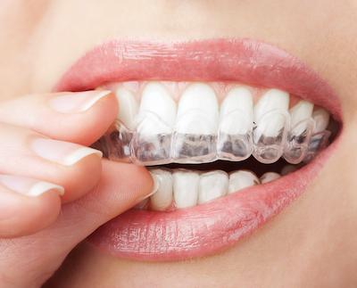 woman putting in clear Invisalign aligner l Bloomington cosmetic dentist