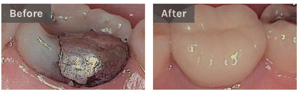 dental crowns before and after | dentist bloomington in