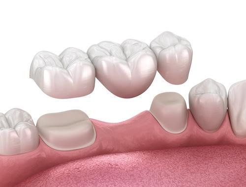 close up of dental bridge in jaw | dental implants bloomington in