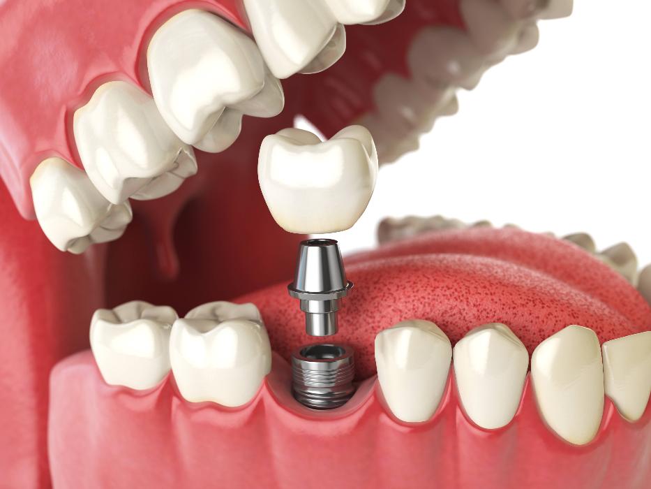 sideview of dental implant | dental implants bloomington in