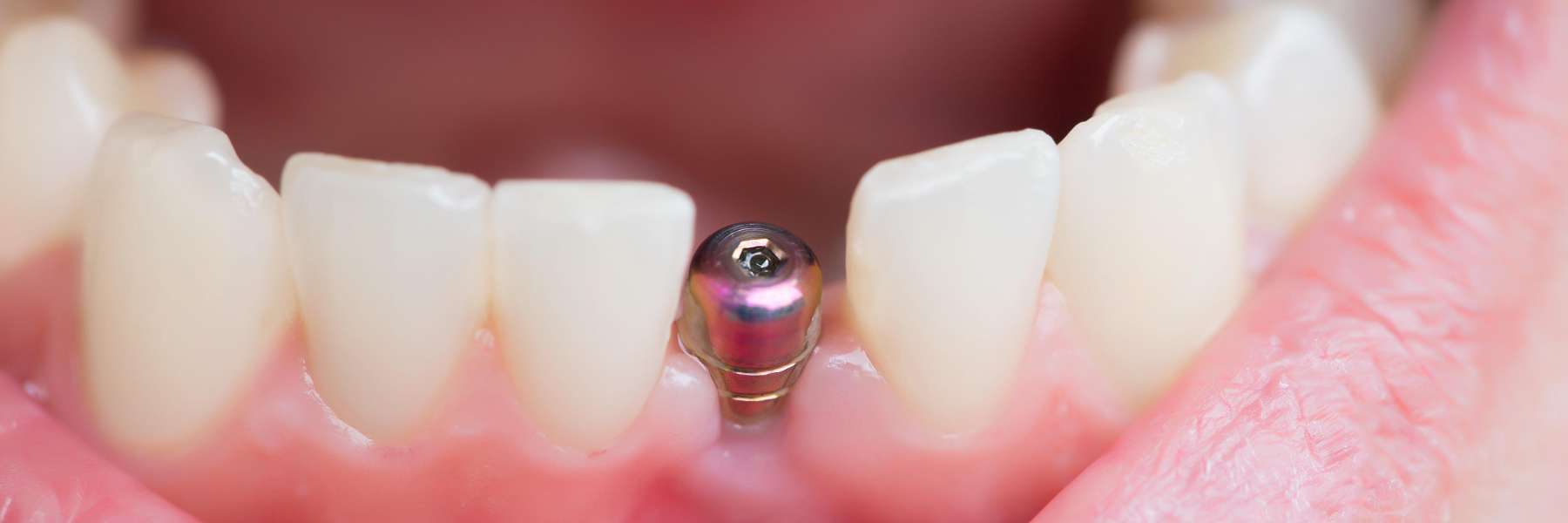 close up of dental implant in mouth | bloomington indiana dentist