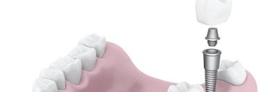 close up of dental implant going in jaw | bloomington indiana dentist