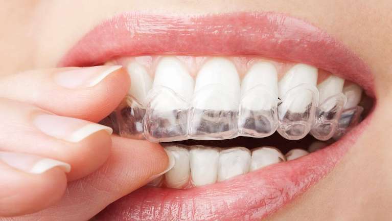 patient putting in clear plastic aligner | invisalign bloomington indiana