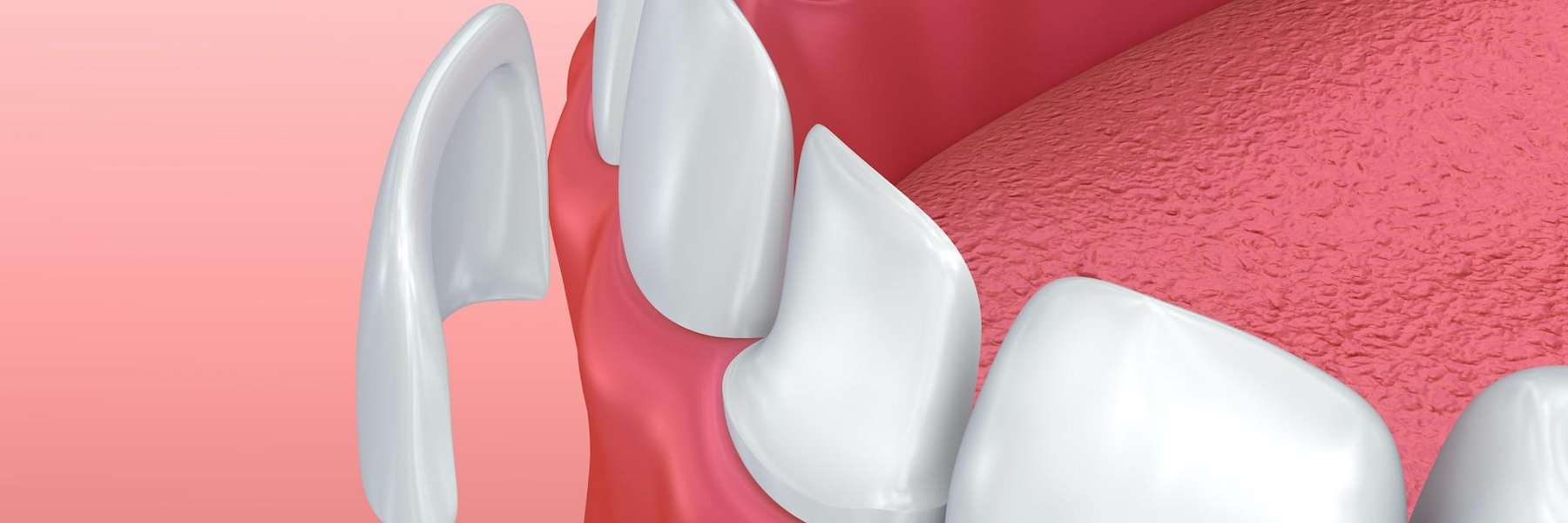close up of porcelain veneer | veneers bloomington in