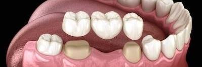 close up of dental bridge l bloomington cosmetic dentist